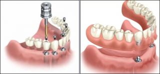 Dental Implants Fixed Bridge and Overdentures