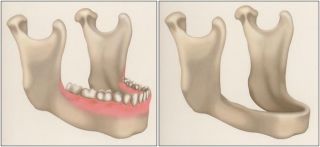 Bone Resorption - Dental Implants