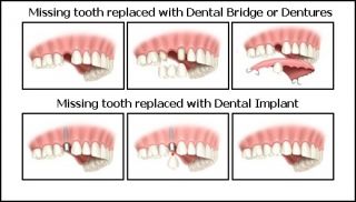 Dental Implants Benefits
