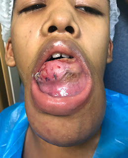 Paciente masculino, 12 años de edad con antecedentes mórbidos conocidos